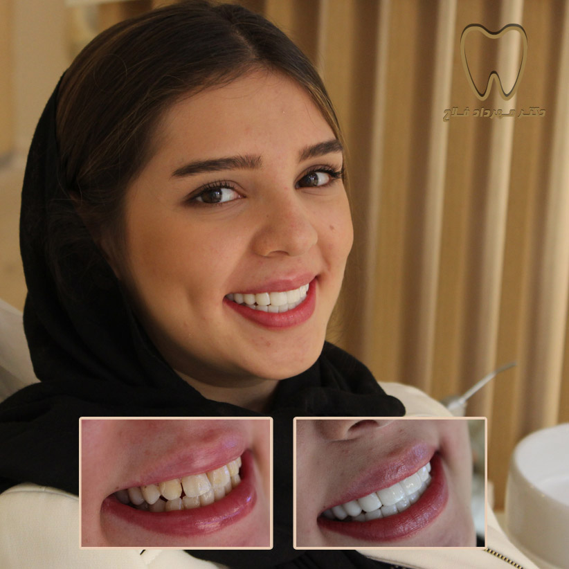 مشاوره زیبایی دندان
