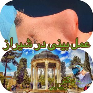 مشاوره جراحی زیبایی بینی شیراز
