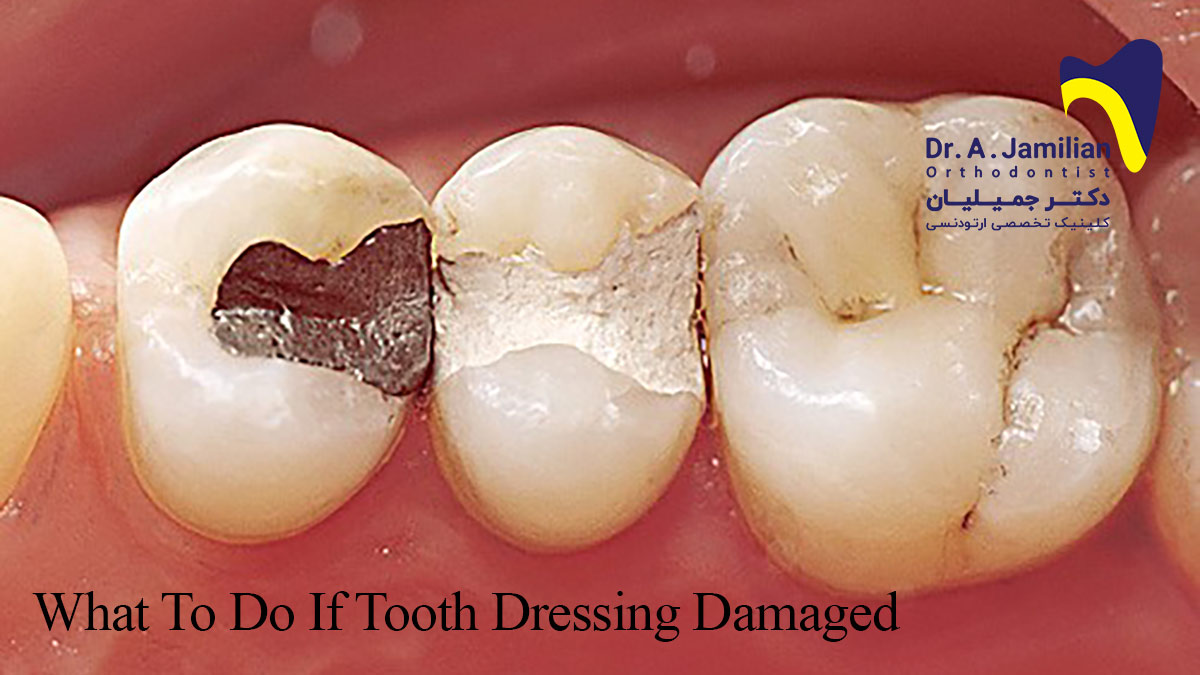 چگونه در خانه دندان را عصب کشی کنیم
