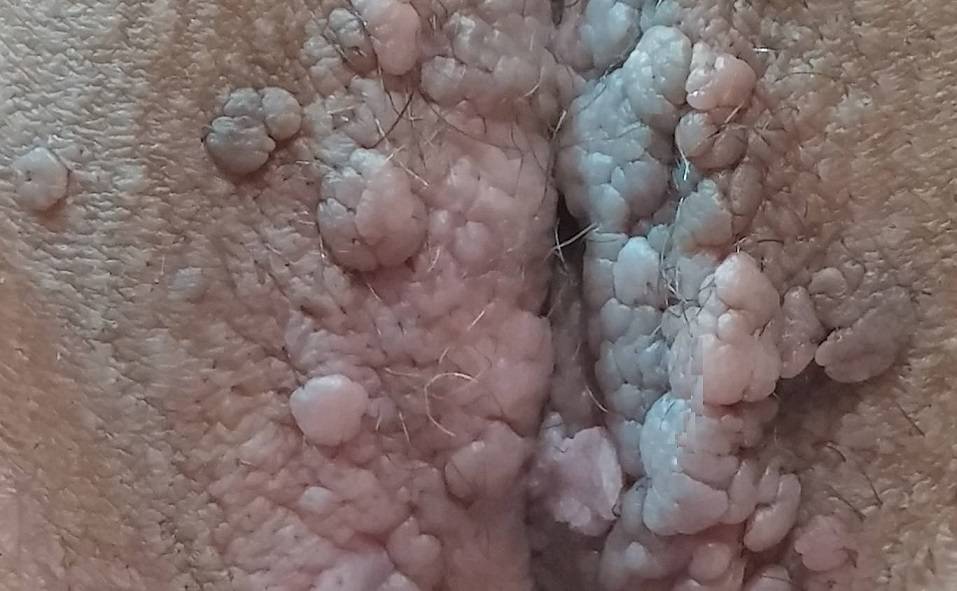 تصویر زگیل تناسلی داخل واژن