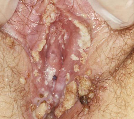عکس زگیل تناسلی داخل واژن