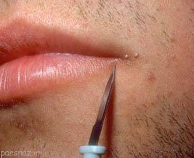 راه درمان زگیل تناسلی در دهان
