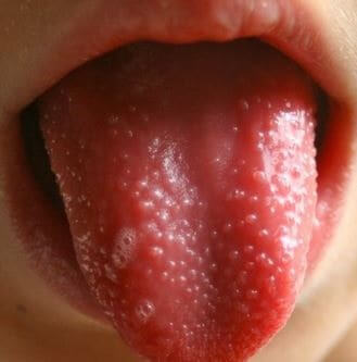 راه درمان زگیل تناسلی در دهان
