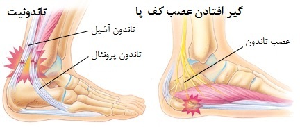 علل درد کف پا راست
