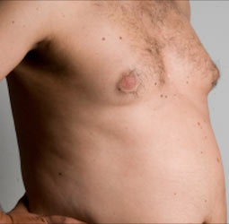 عکس سرطان سينه در مردان
