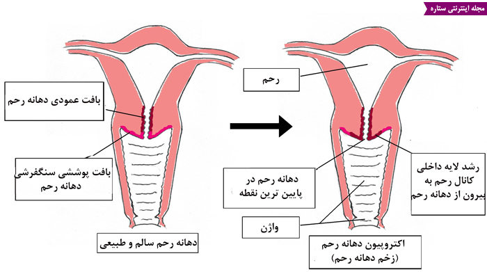 درمان زخم شدن دهانه واژن

