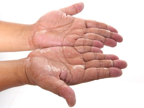 درمان اگزماي شديد پوست دست
