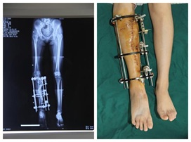 درمان پاهاي پرانتزي با جراحي
