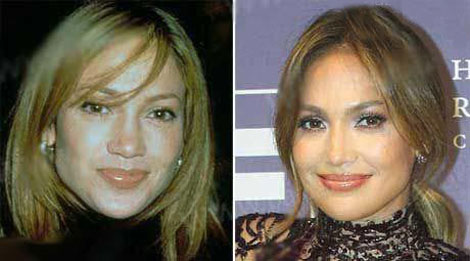 عکس جنیفر لوپز قبل و بعد از عمل زیبایی