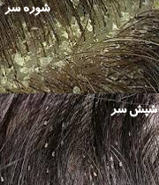 عکس انواع شپش موی سر