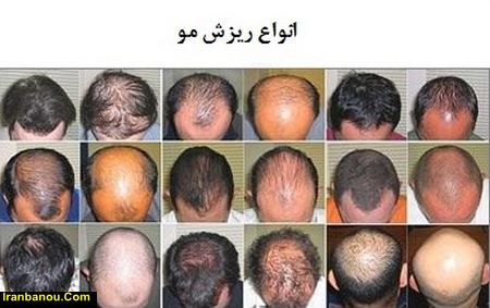 علت ريزش موي پا مردان
