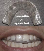 راههاي درمان دندان قروچه کودکان
