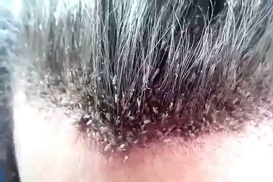 درمان رشک مو با سرکه
