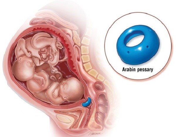 مدت زمان استفاده از شیاف پروژسترون در بارداری