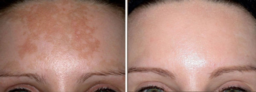 درمان لک های قهوه ای صورت با لیزر
