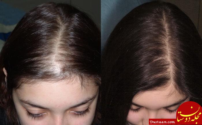 درمان ریزش مو هورمونی در زنان با طب سنتی
