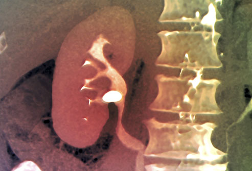 image of 7mm kidney stone