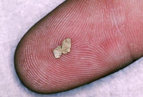 image of 5mm kidney stone