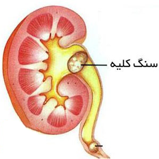 image of kidney stone on ultrasound