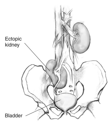 photo of kidney pain location