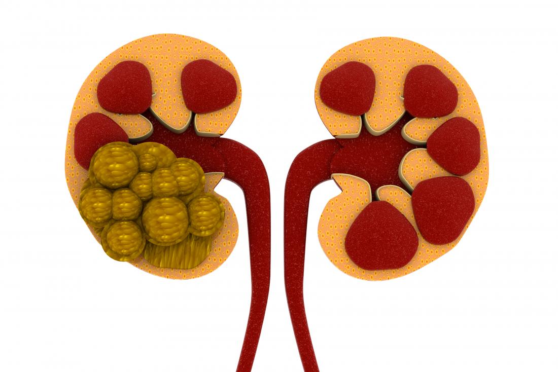 pics of kidney stones