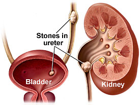 image of kidney stones from energy drinks