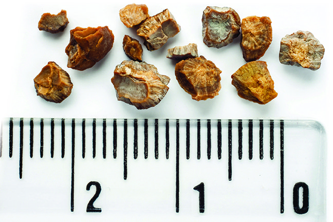 image of kidney stones
