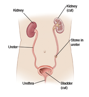 image of kidney stone in ureter
