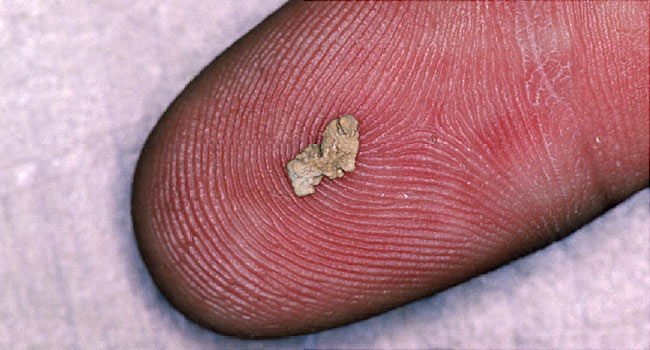 show a picture of a 3mm kidney stone