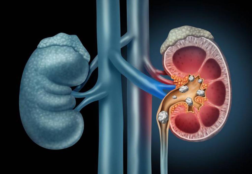 image of kidney stones on ct