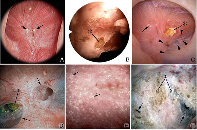 pics of kidney stone pain