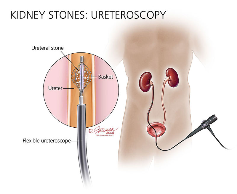 picture of kidney stone in ureter