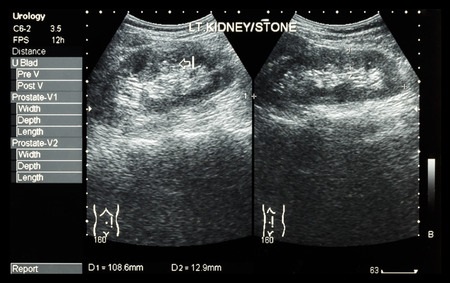 picture of kidney stone on ultrasound