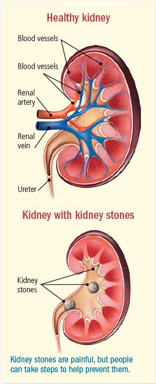 pics of kidney stone pain
