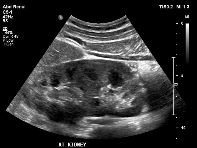 ultrasound pictures of healthy kidney
