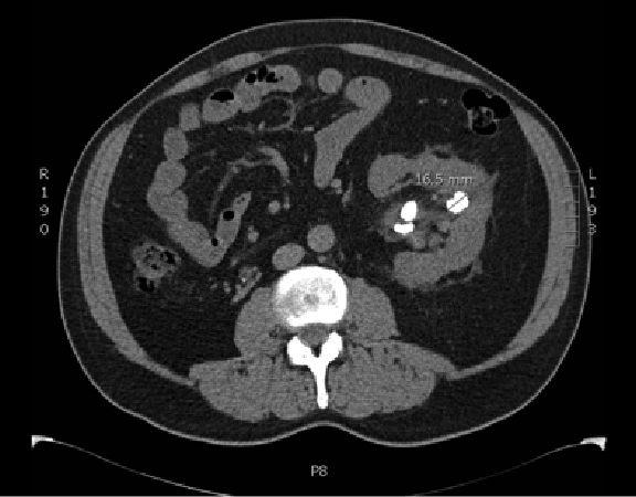 image of kidney stones on ct

