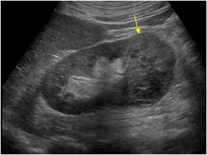 ultrasound pictures of kidney tumors
