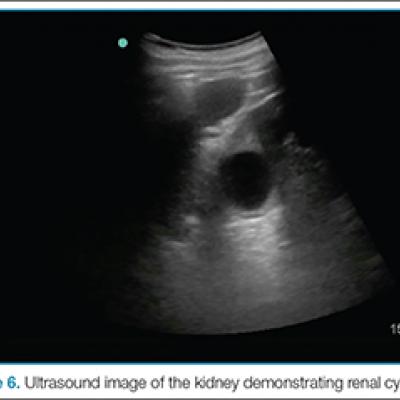 picture of kidney stone on ultrasound