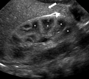ultrasound pictures of normal kidney