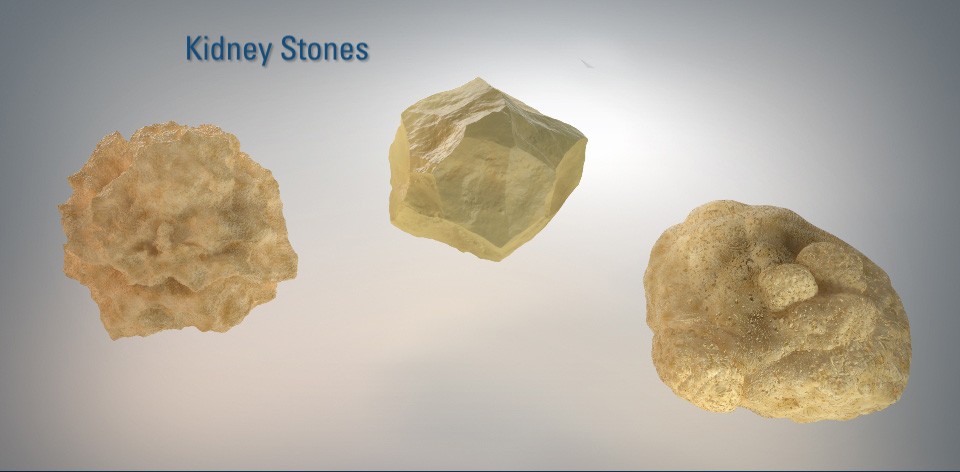 pictures of kidney stones in urine