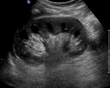 ultrasound pictures of healthy kidney