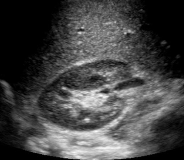 ultrasound pictures of normal kidney