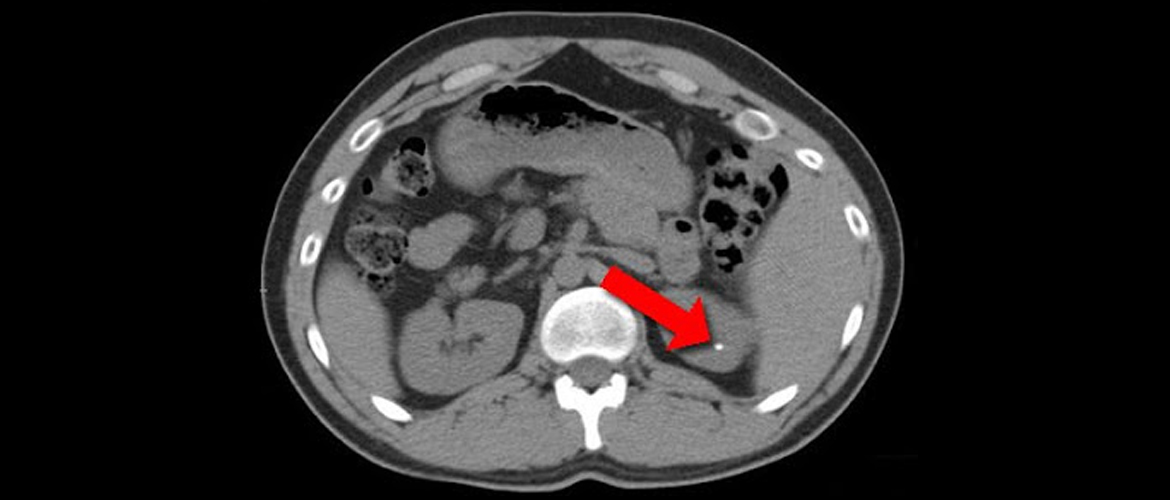 images of kidney stones on ct scan