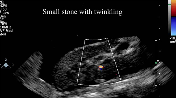 image of kidney stone on ultrasound
