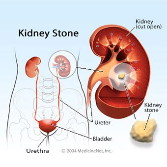 images of kidney stones in bladder