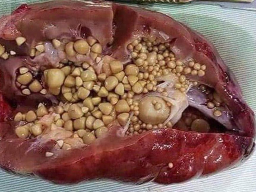pictures of kidney stones in the liver