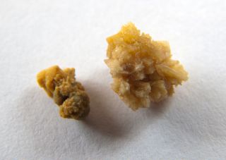 pictures of kidney stones in the bladder