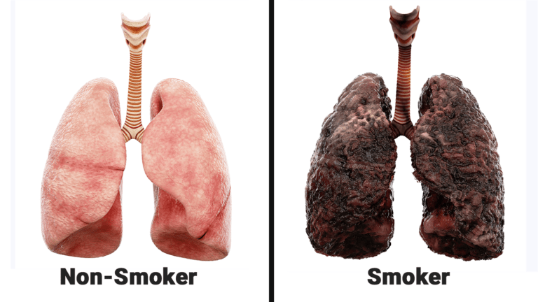 what lungs look like from smoking
