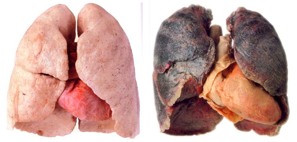 photos of damaged lungs from smoking