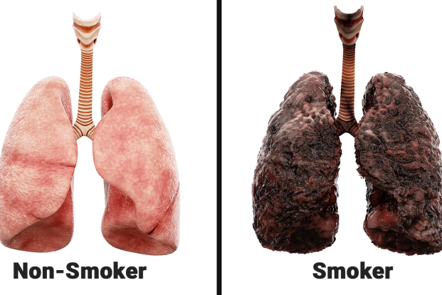 what does smokers lungs look like